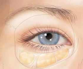 祛眼袋手术失败有什么样的症状呢？