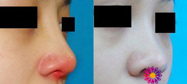 膨体隆鼻失败修复需要去除膨体假体吗？损伤多大？