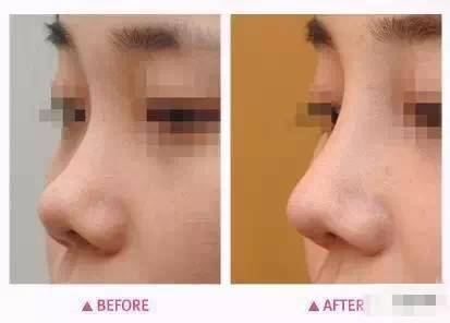 硅胶能经常保留鼻子里吗？有损害吗？