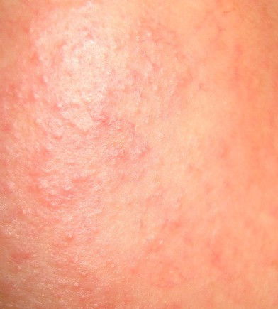 皮肤到冬季就过敏，痒是怎么回事