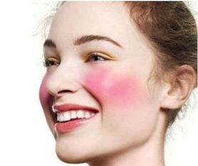 激光美容医脸部红血丝价位会是多少呢？成效好不好？