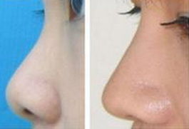 鼻尖整形手术方法有哪些？