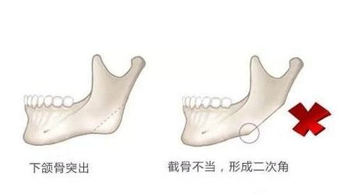下颌角截骨哪家医院好？台州下颌角截骨方法和价格