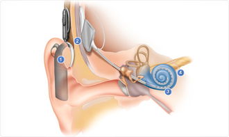 植入人工耳蜗需要多久恢复听力