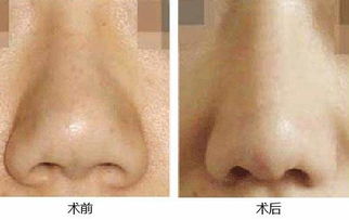 鼻小柱缺失可恢复到正常形状吗？怎么治？
