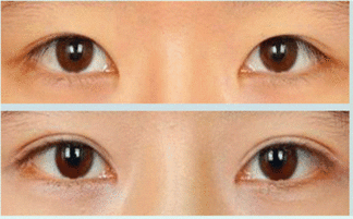 北京哪个医院做双眼皮做得好？