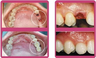 种植牙过程有痛苦吗？
