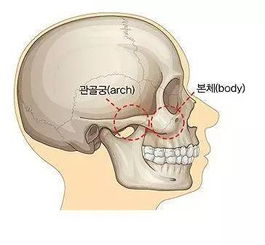 韩式颧骨、颧弓降低术技术特点是怎么样的？