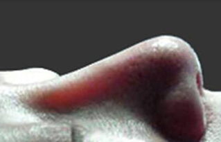 隆鼻20年后一侧鼻孔经常出血和假体有关系吗