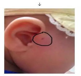谈了5个月发现男朋友一边的耳朵是先天性畸形