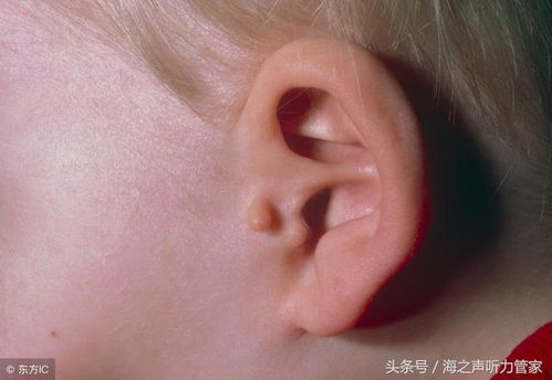 残耳、无耳垂矫治过后是否自然