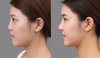分段式隆鼻相比传统隆鼻有什么优点？