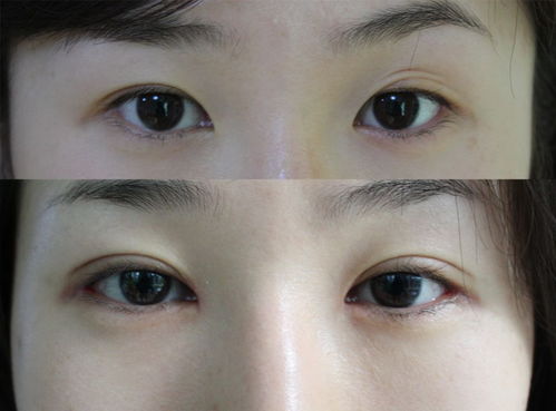 北京哪做双眼皮手术好 价格在1000-2000之内的