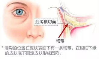 外切去眼袋后多久能恢复，出现泪沟凹陷是正常现象吗？