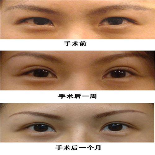 双眼皮修复术有几种方法