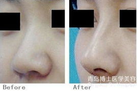 有鼻中隔缺损实行哪一个鼻小柱缺损改善术式
