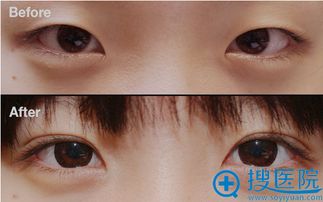 武汉五洲美莱的双眼皮割得怎么样？效果好吗？