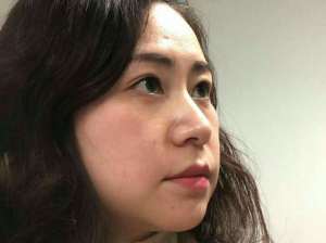 谁去过重庆超雅医学美容研究所做过超生波去眼袋？效果怎么样？