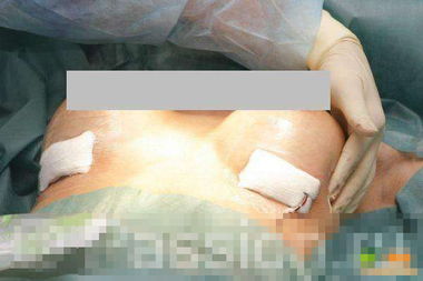 假体隆胸手术过程是怎样的？
