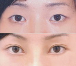 双眼皮整形有哪些手术方法？
