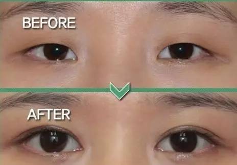 韩式双眼皮手术有些什么办法