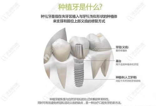 北京种植一颗牙价格多少？费用多少钱？