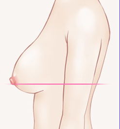 乳房下垂能做乳房整形吗？