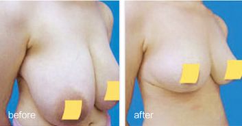 乳房下垂可以乳房整形吗？