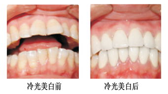 深圳最好的牙齿美白专家是谁？