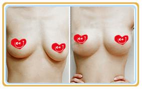 一般乳房下垂可以做乳房整形吗？