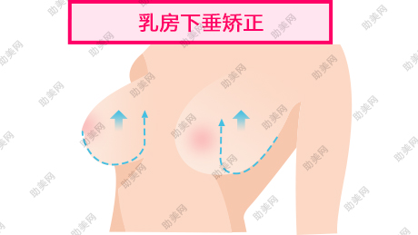 乳房下垂提升术方法有哪些
