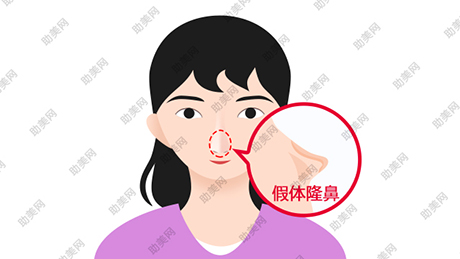 广州华美不佳鼻部形态有哪些