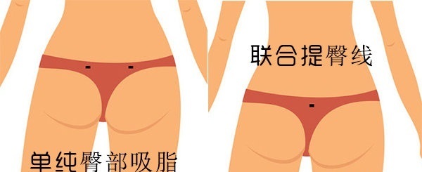 臀部抽脂针眼位置在哪里？臀部<a href='/tag_xizhishoushu7.html'>吸脂手术</a>后针眼护理有哪些注意事项？