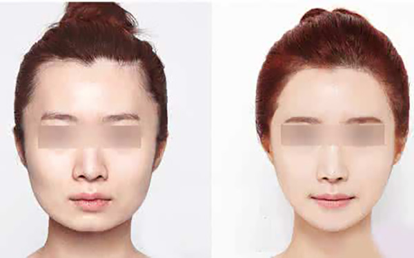 南京天然Botox打针多少钱