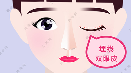 <a href='/tag_hanshigeshuangyan3.html'>韩式割双眼皮</a>手术的特点是什么