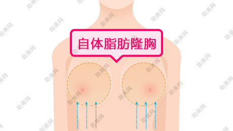 自体<a href='/tag_zhifanglongxiong5.html'>脂肪隆胸</a>手术的特点有哪些